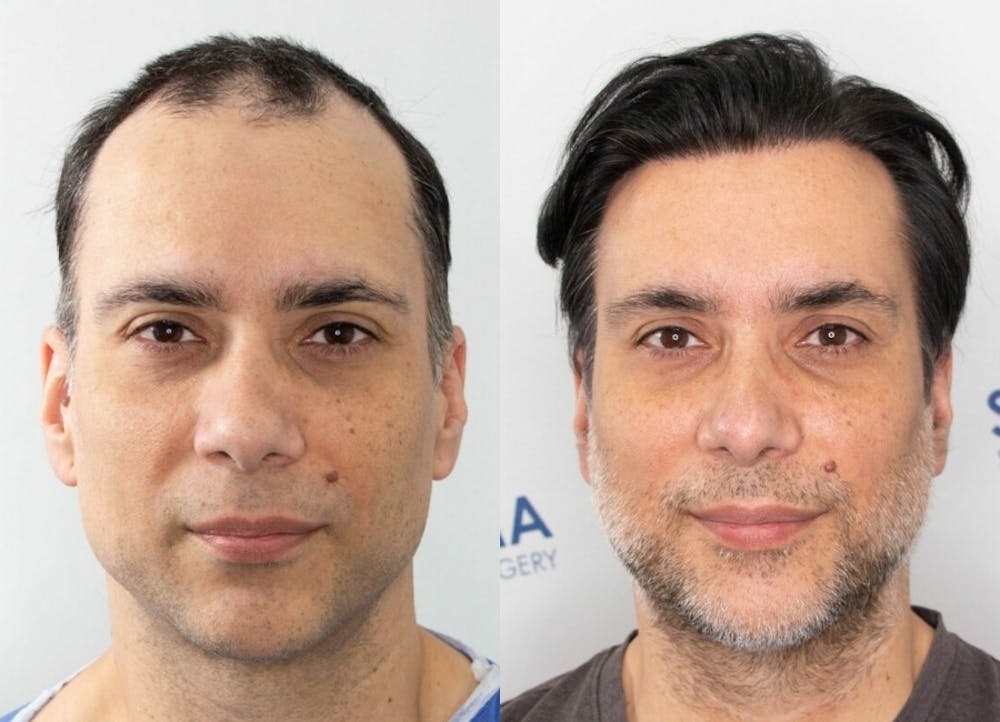 This is one of our beautiful hair transplant patient #10