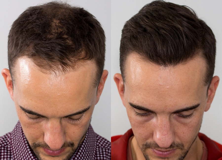 This is one of our beautiful hair transplant patient 7