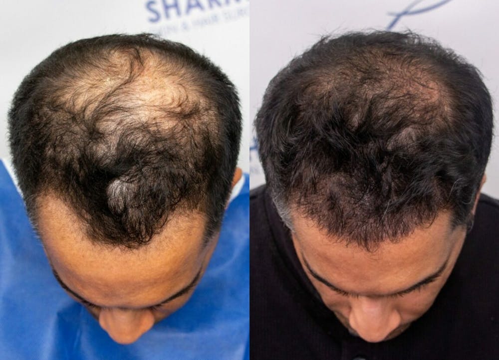 This is one of our beautiful hair transplant patient #4
