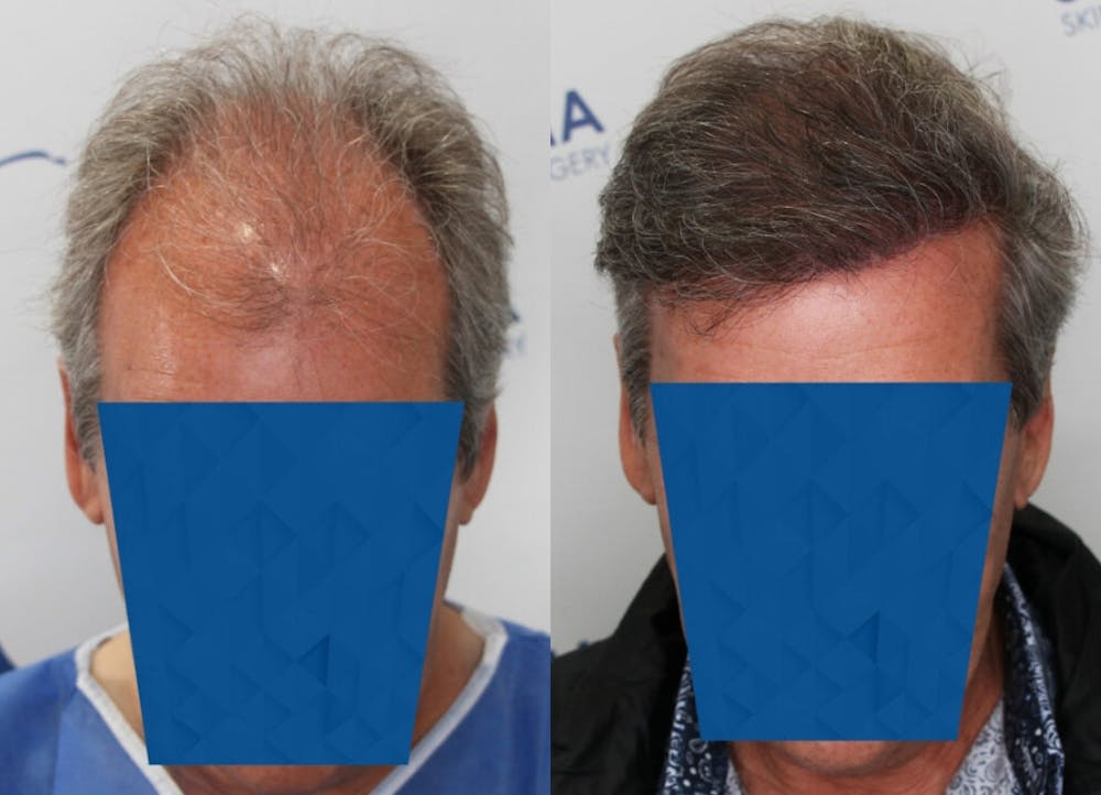 This is one of our beautiful hair transplant patient #3