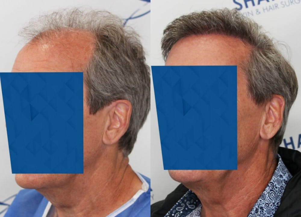 This is one of our beautiful hair transplant patient #3