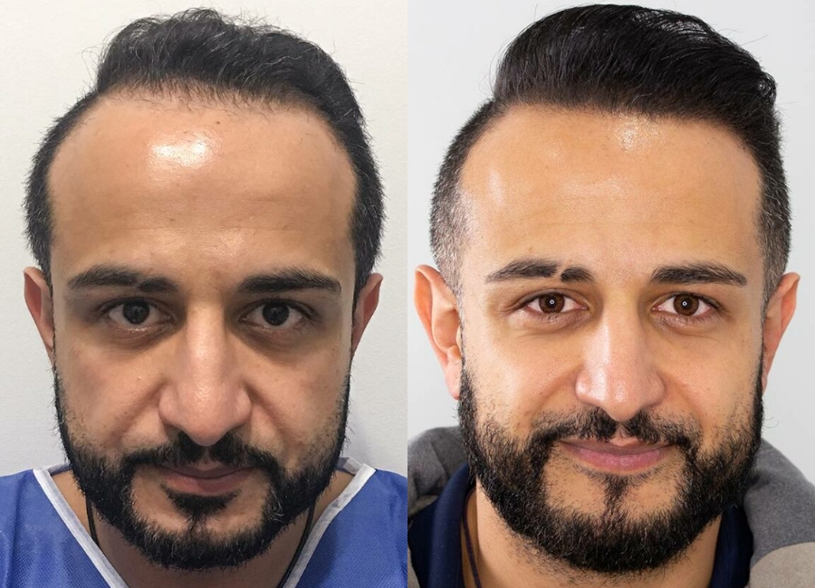 This is one of our beautiful hair transplant patient 5