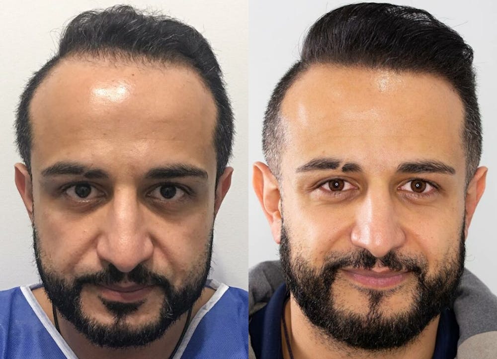 This is one of our beautiful hair transplant patient #5