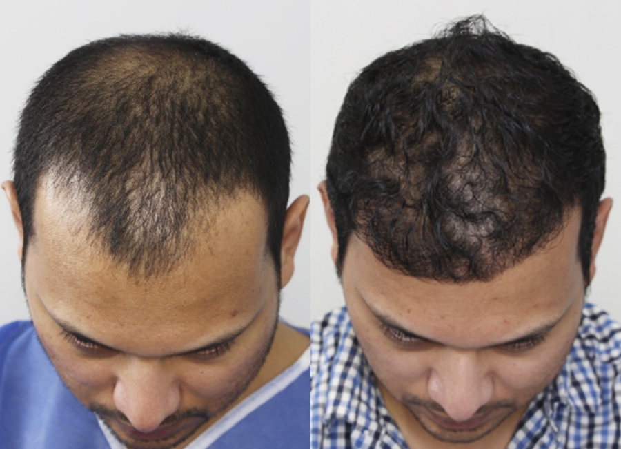 This is one of our beautiful hair transplant patient 6