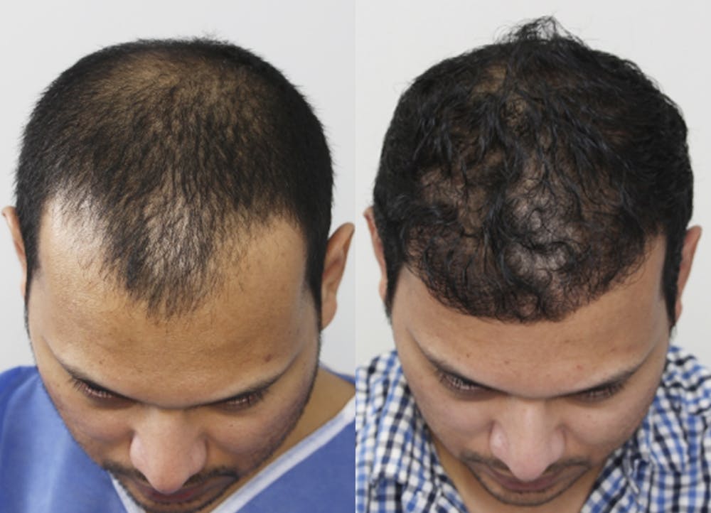 This is one of our beautiful hair transplant patient #6