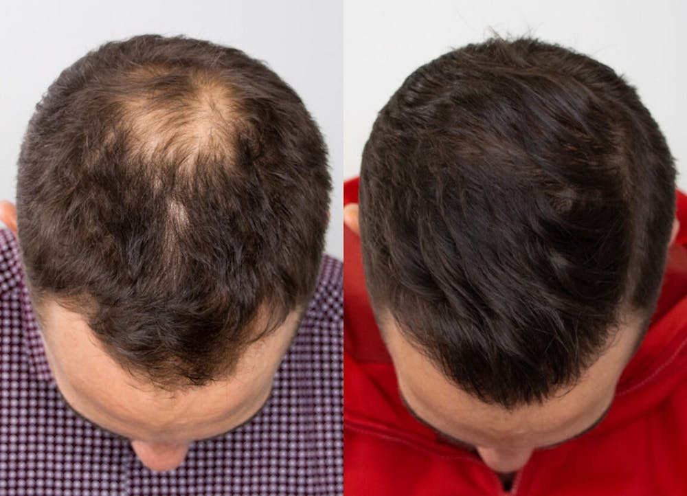 This is one of our beautiful hair transplant patient #7