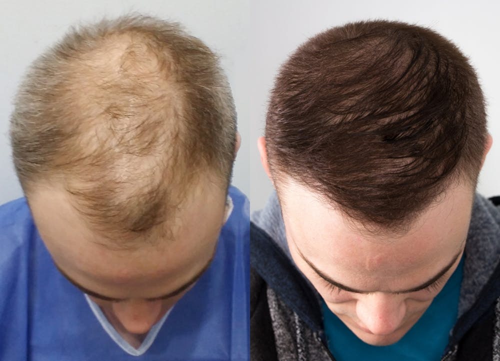 This is one of our beautiful hair transplant patient #8