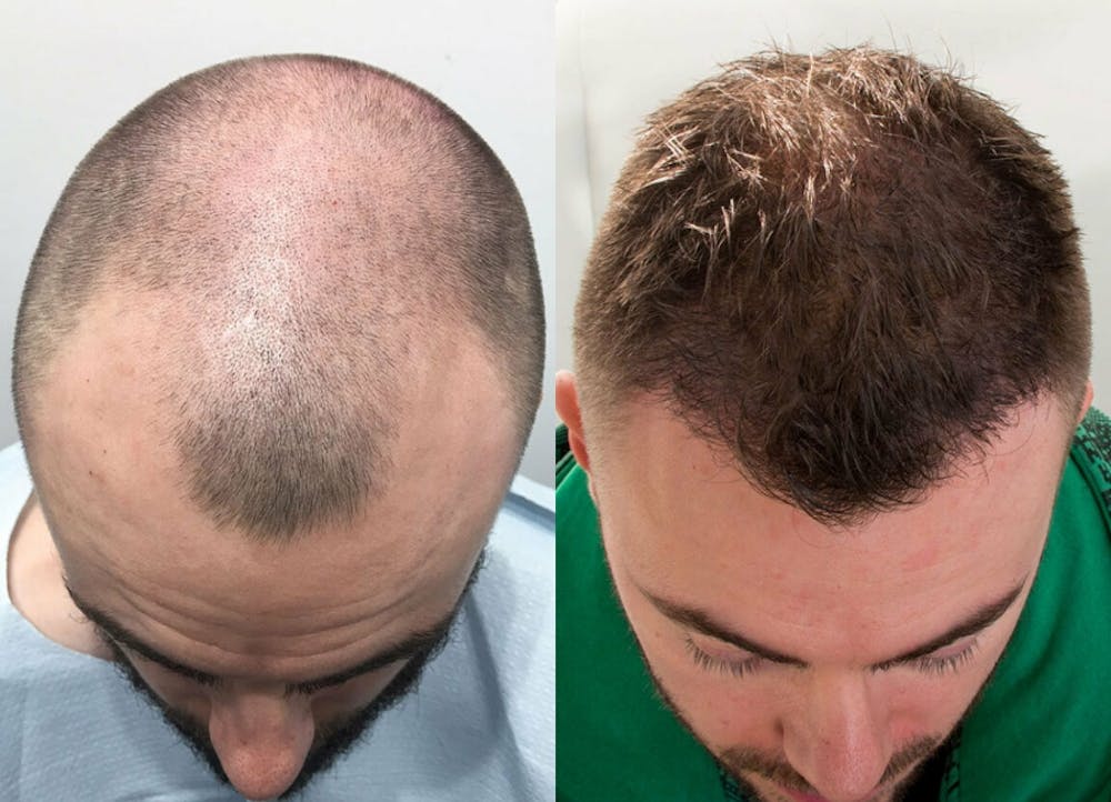 This is one of our beautiful hair transplant patient #1
