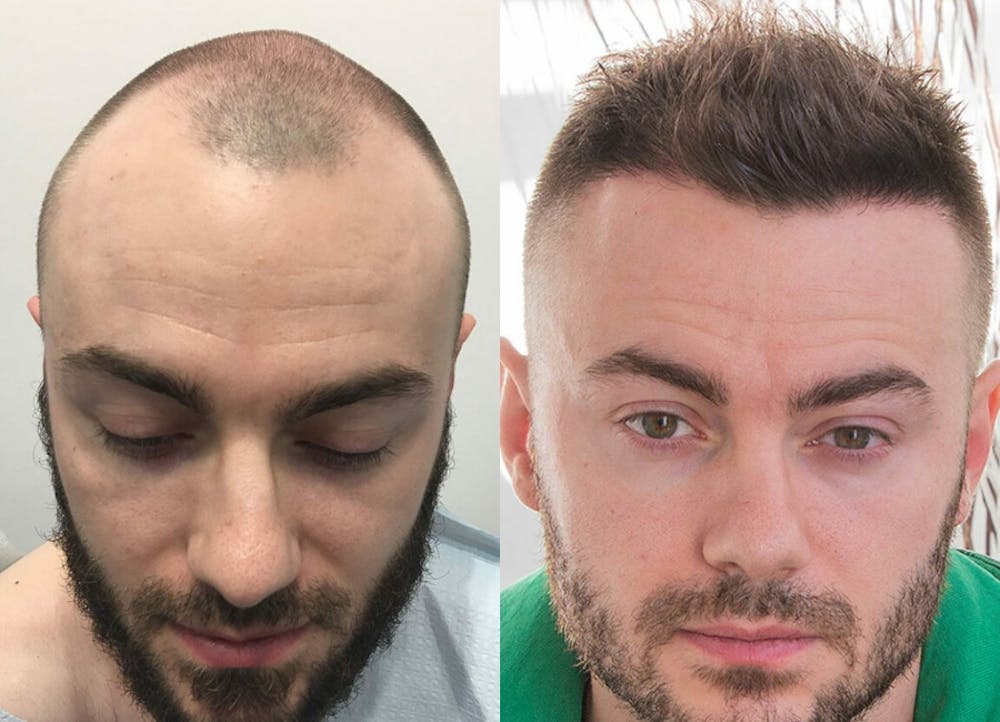 This is one of our beautiful hair transplant patient #1