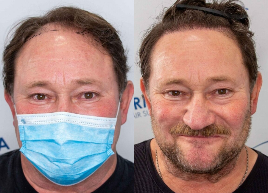 This is one of our beautiful hair transplant patient 2
