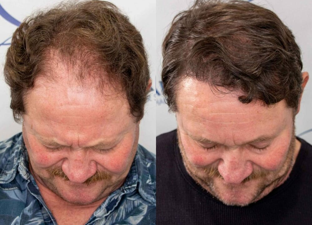This is one of our beautiful hair transplant patient #2