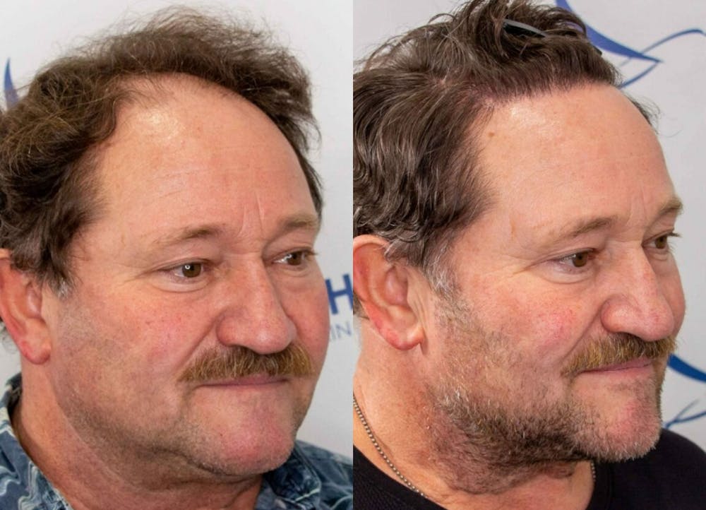 This is one of our beautiful hair transplant patient #2