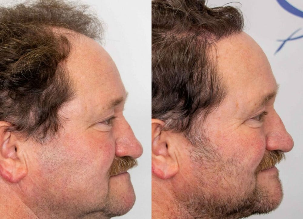 This is one of our beautiful hair transplant patient #2