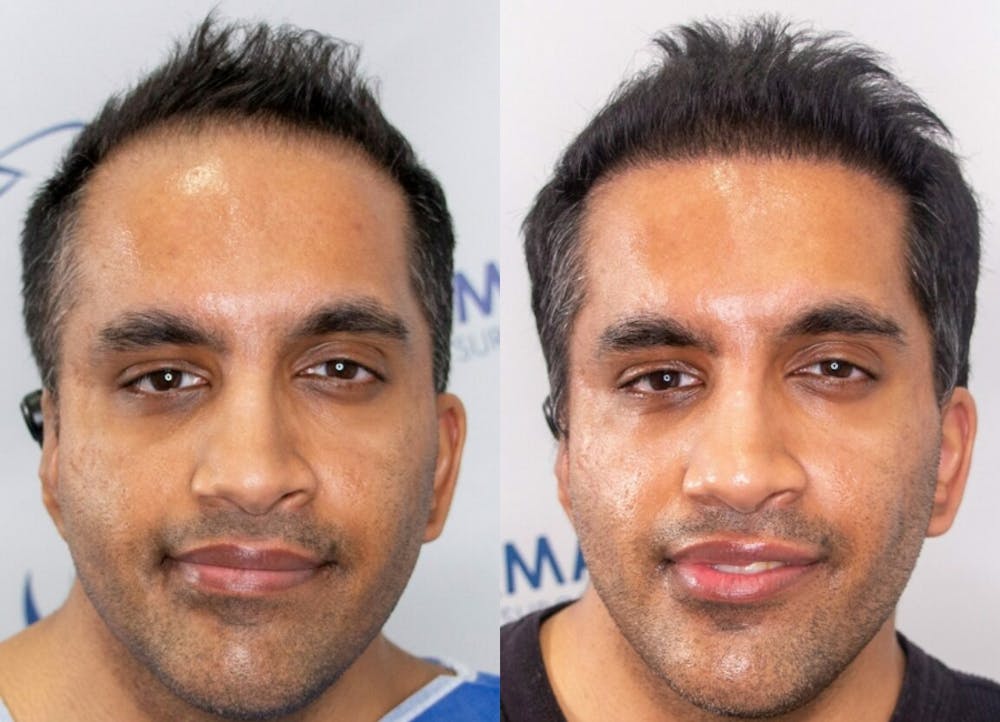 This is one of our beautiful hair transplant patient #4