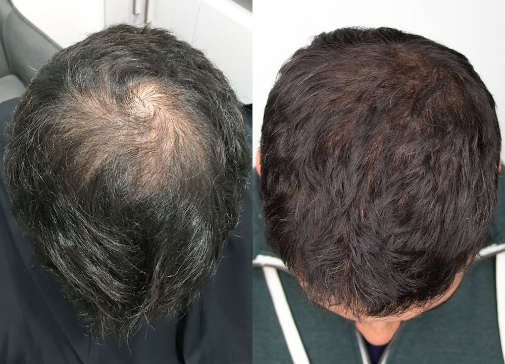 This is one of our beautiful hair transplant patient #9