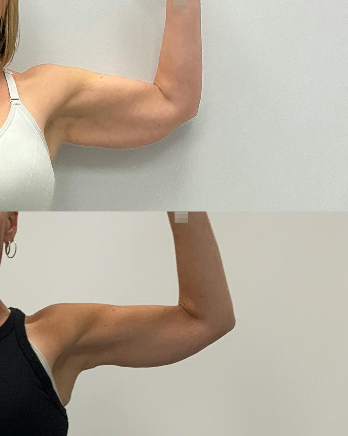 Arm Lift Before & After Gallery - Patient 238543 - Image 2