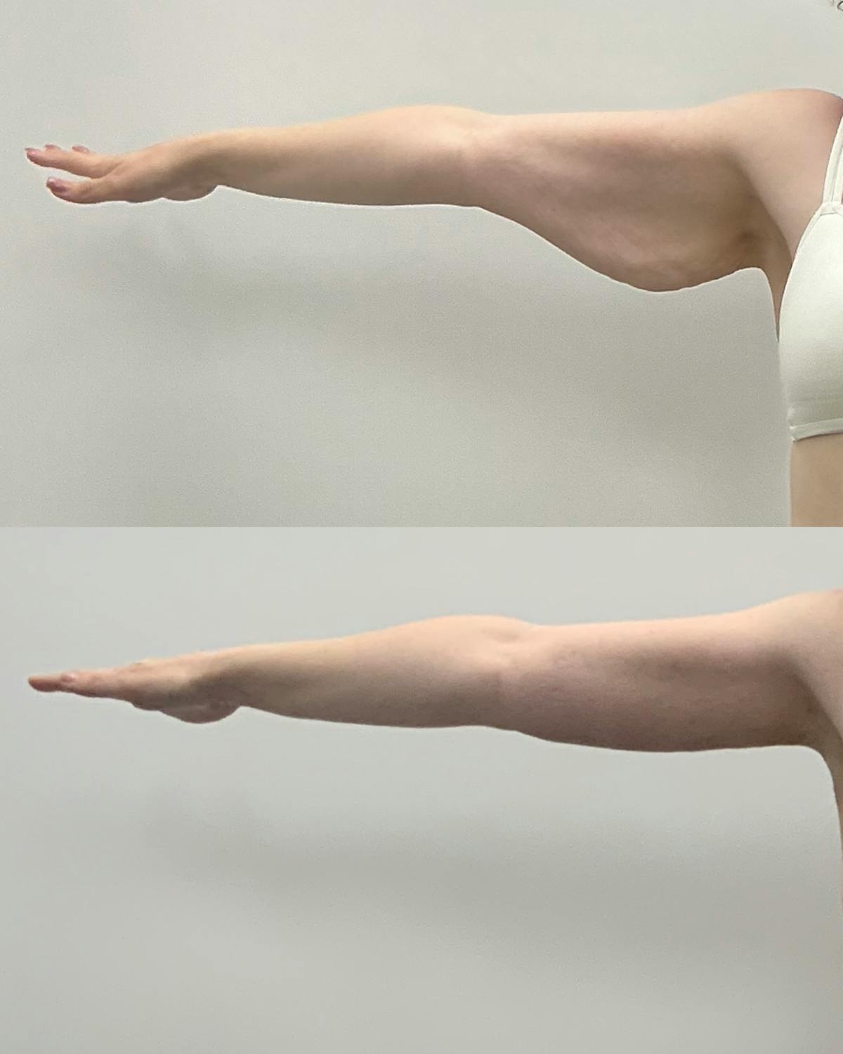 Arm Lift Before & After Gallery - Patient 702808 - Image 2