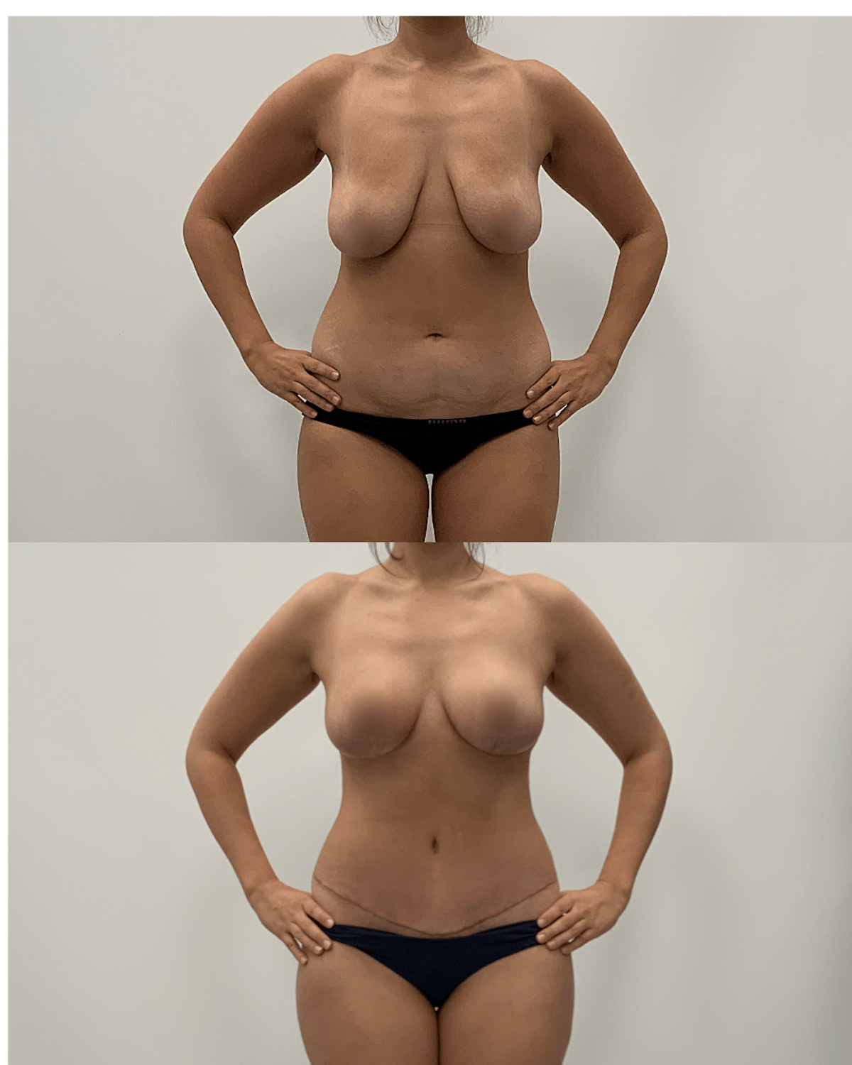 Mommy Makeover Before & After Gallery - Patient 379603 - Image 1
