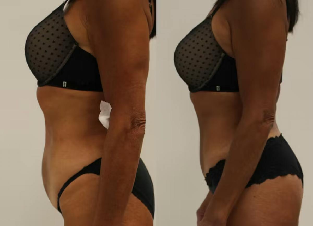 Tummy Tuck Before & After Gallery - Patient 630991 - Image 4