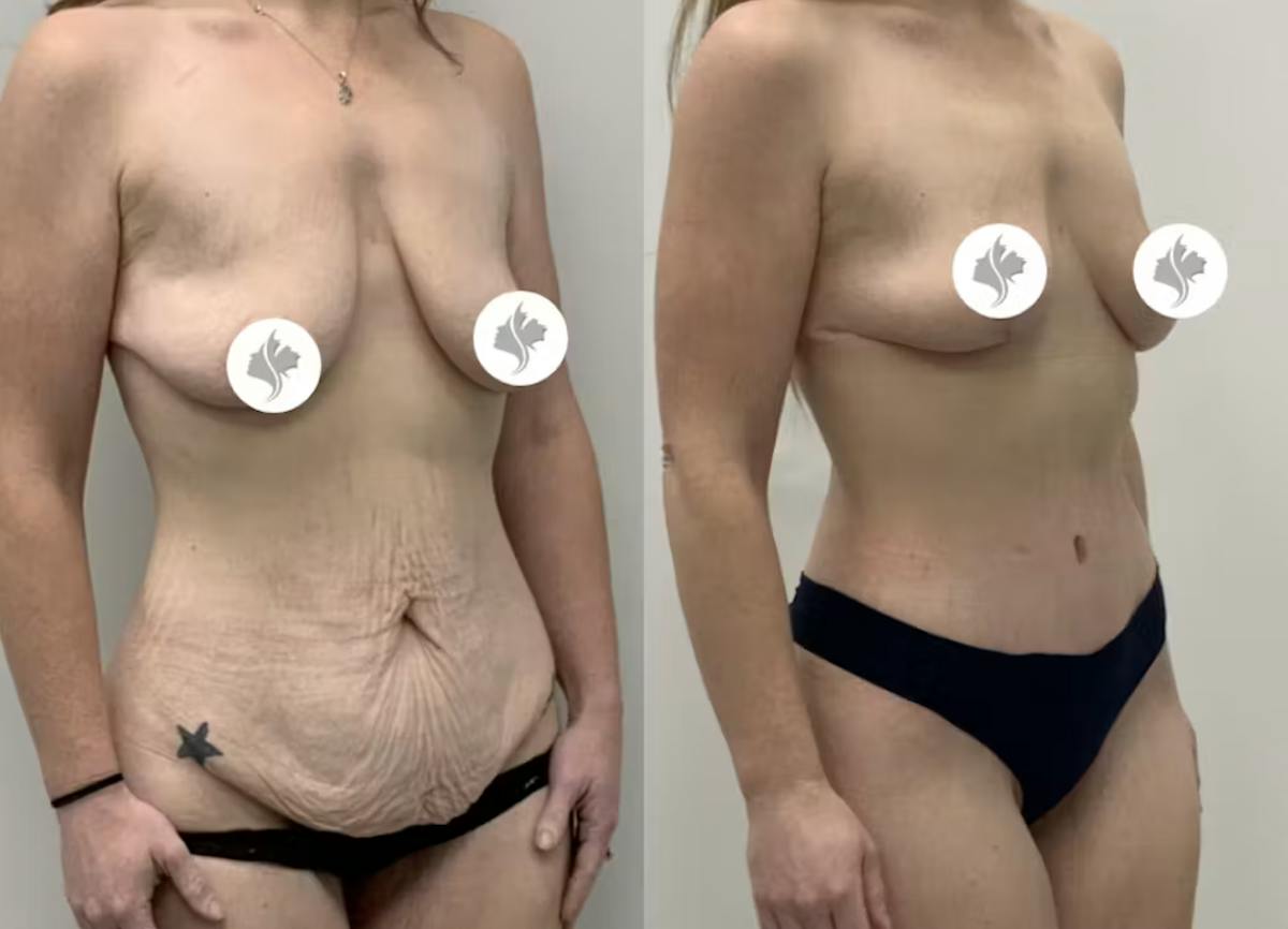 Tummy Tuck Before & After Gallery - Patient 402216 - Image 2