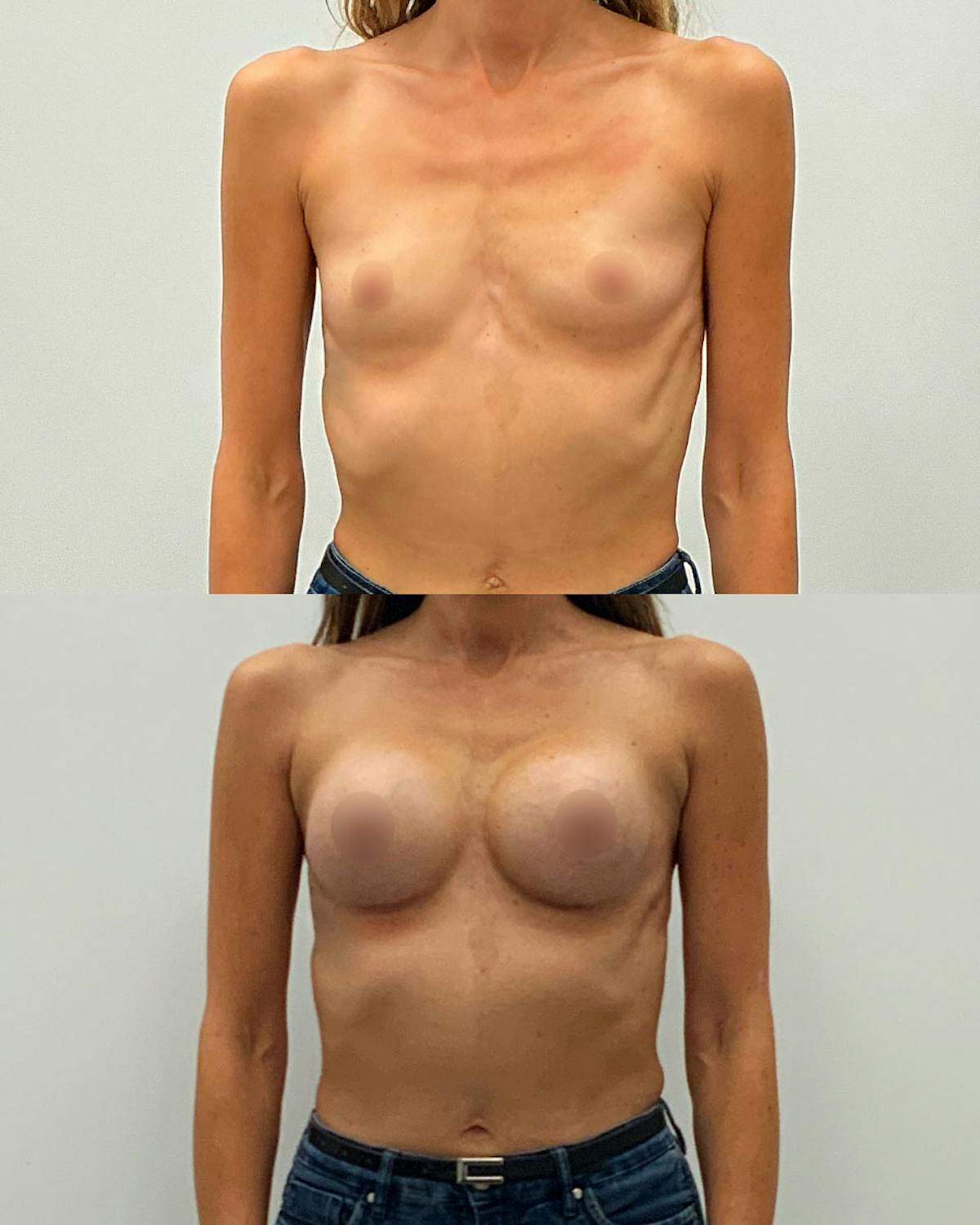 Breast Augmentation Before & After Gallery - Patient 306114 - Image 1