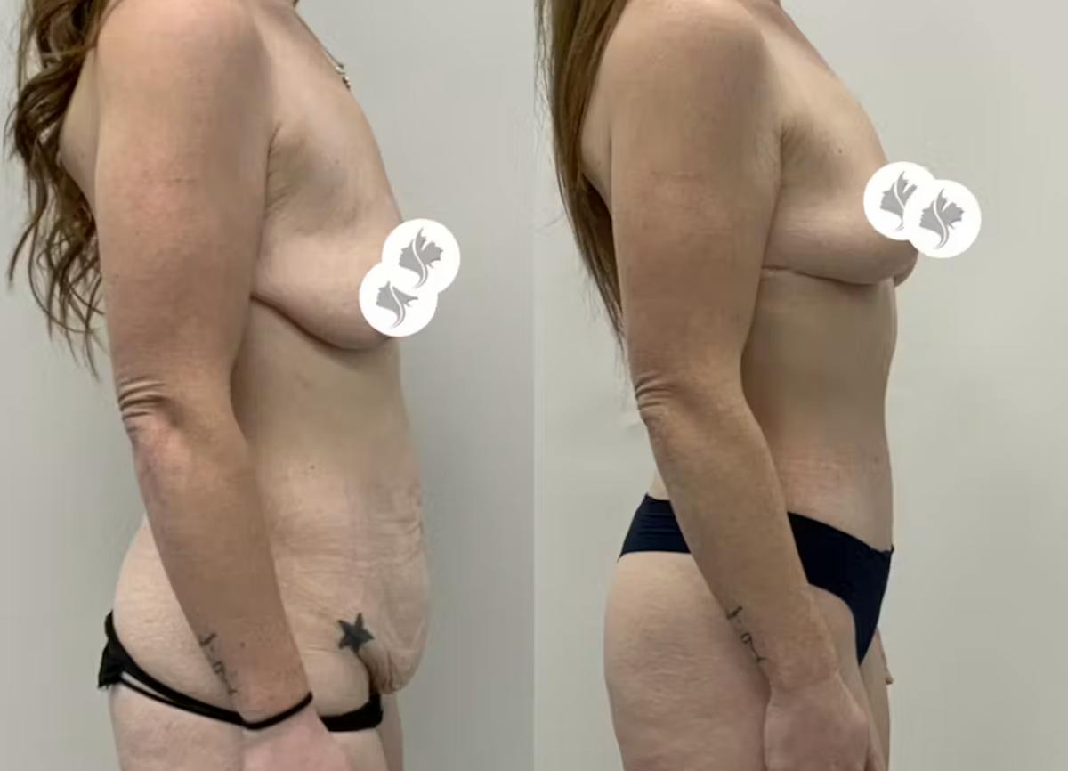 Tummy Tuck Before & After Gallery - Patient 402216 - Image 3