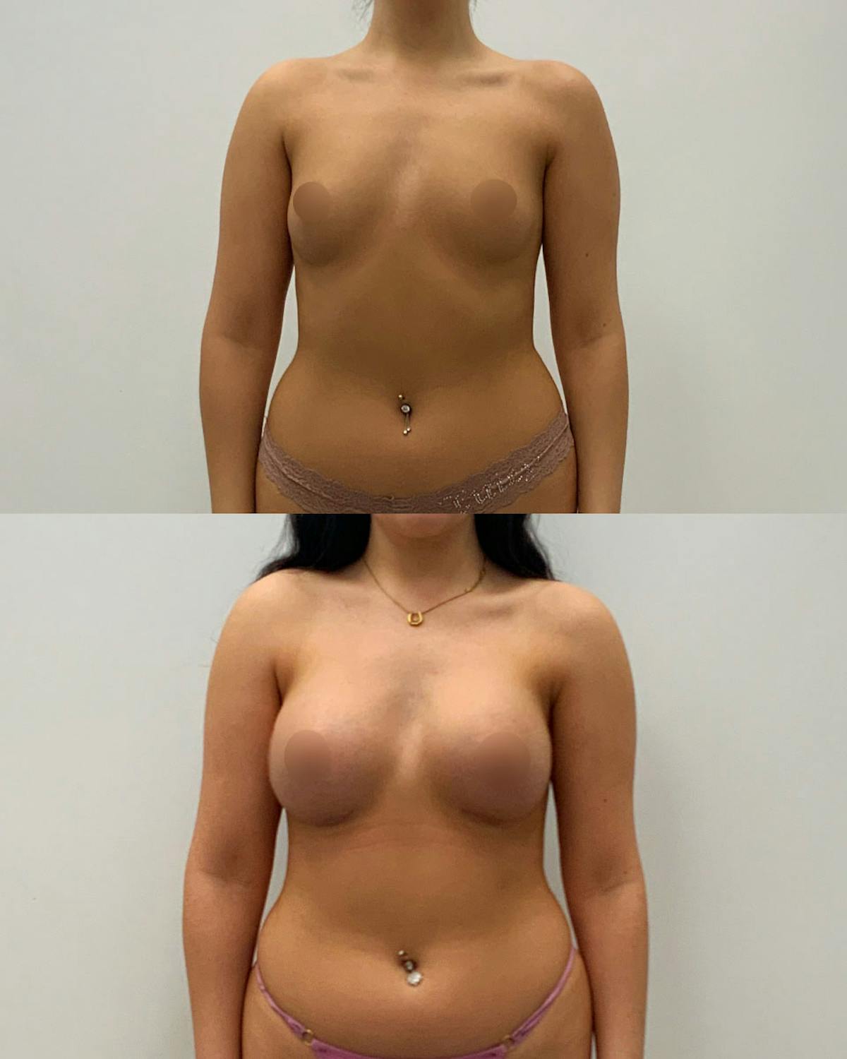 Breast Augmentation Before & After Gallery - Patient 420741 - Image 1