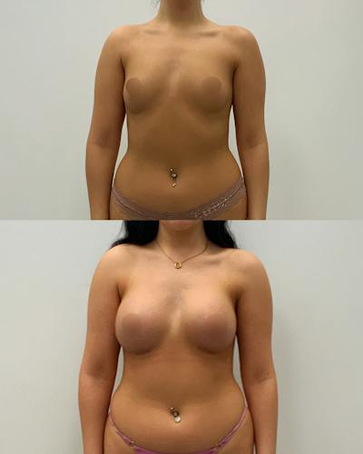 Breast Augmentation Before & After Gallery - Patient 420741 - Image 1