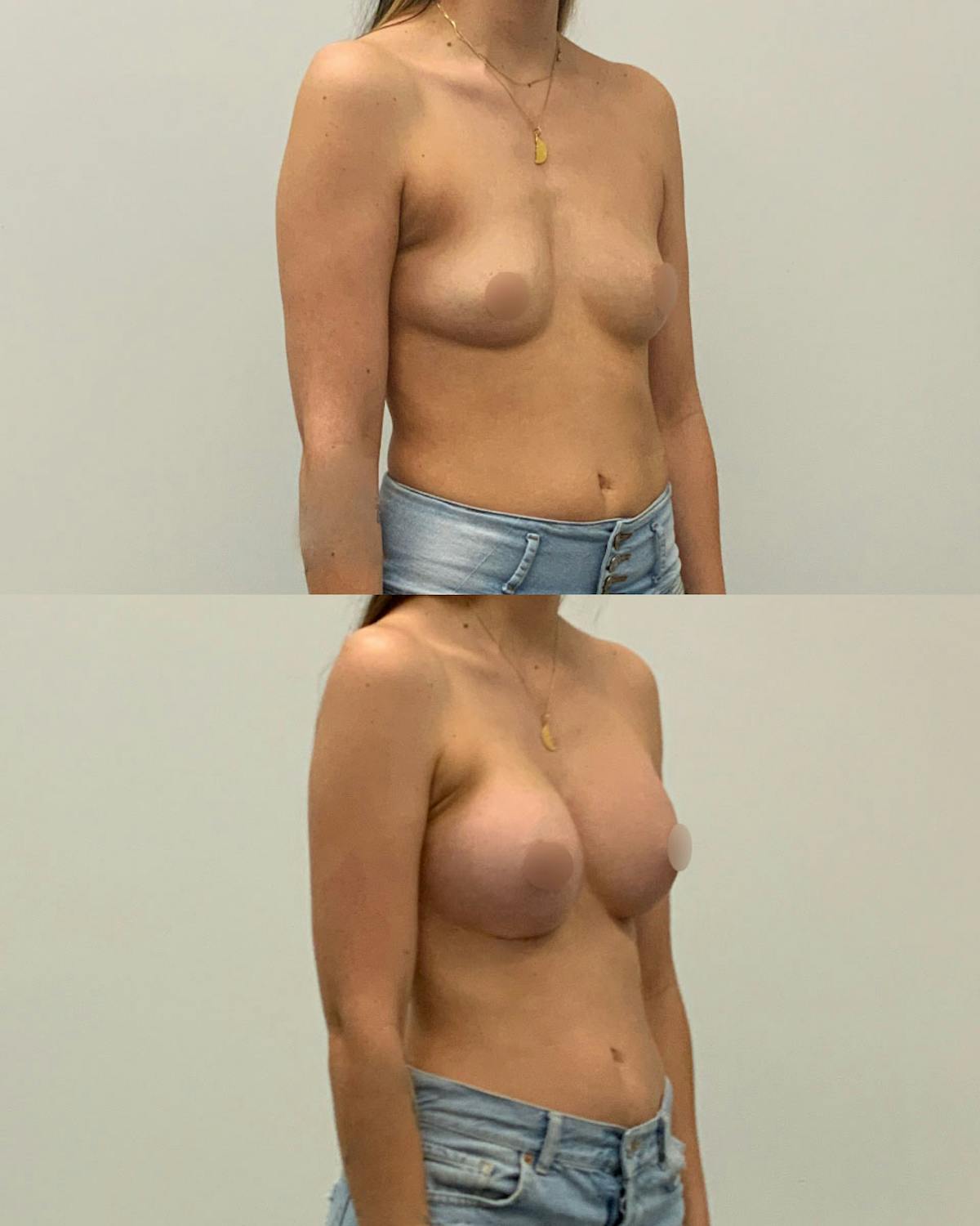 Breast Augmentation Before & After Gallery - Patient 420224 - Image 2