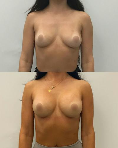 Breast Augmentation Before & After Gallery - Patient 410841 - Image 1
