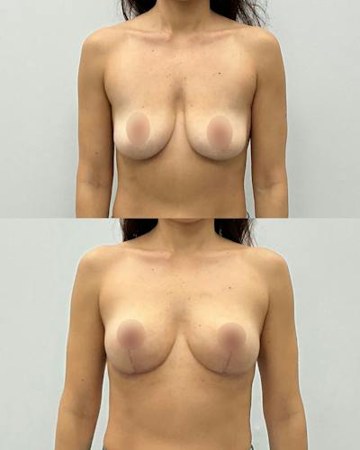 Breast Lift Before & After Gallery - Patient 377832 - Image 1