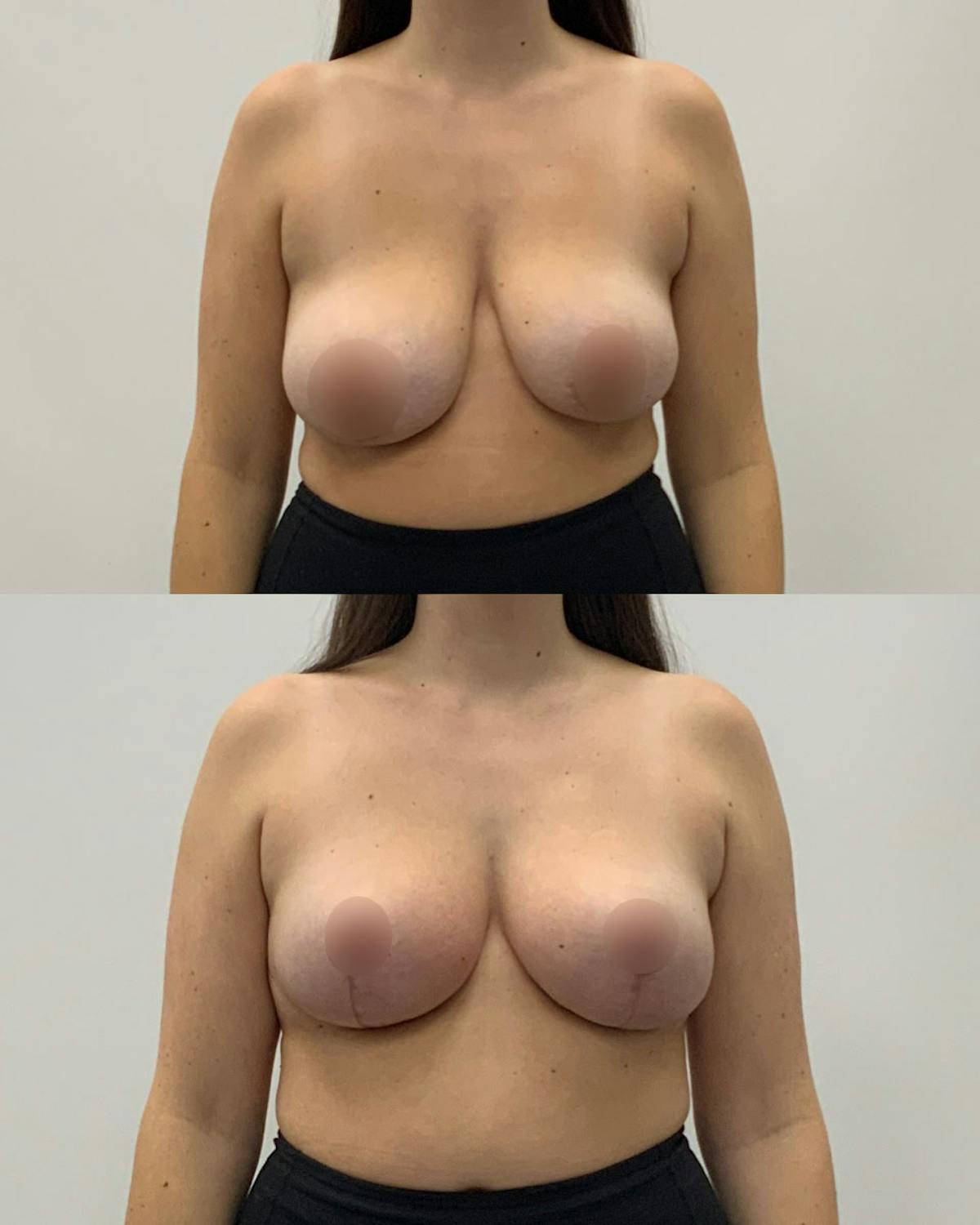 Breast Lift Before & After Gallery - Patient 359567 - Image 1