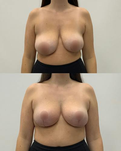 Breast Lift Before & After Gallery - Patient 359567 - Image 1