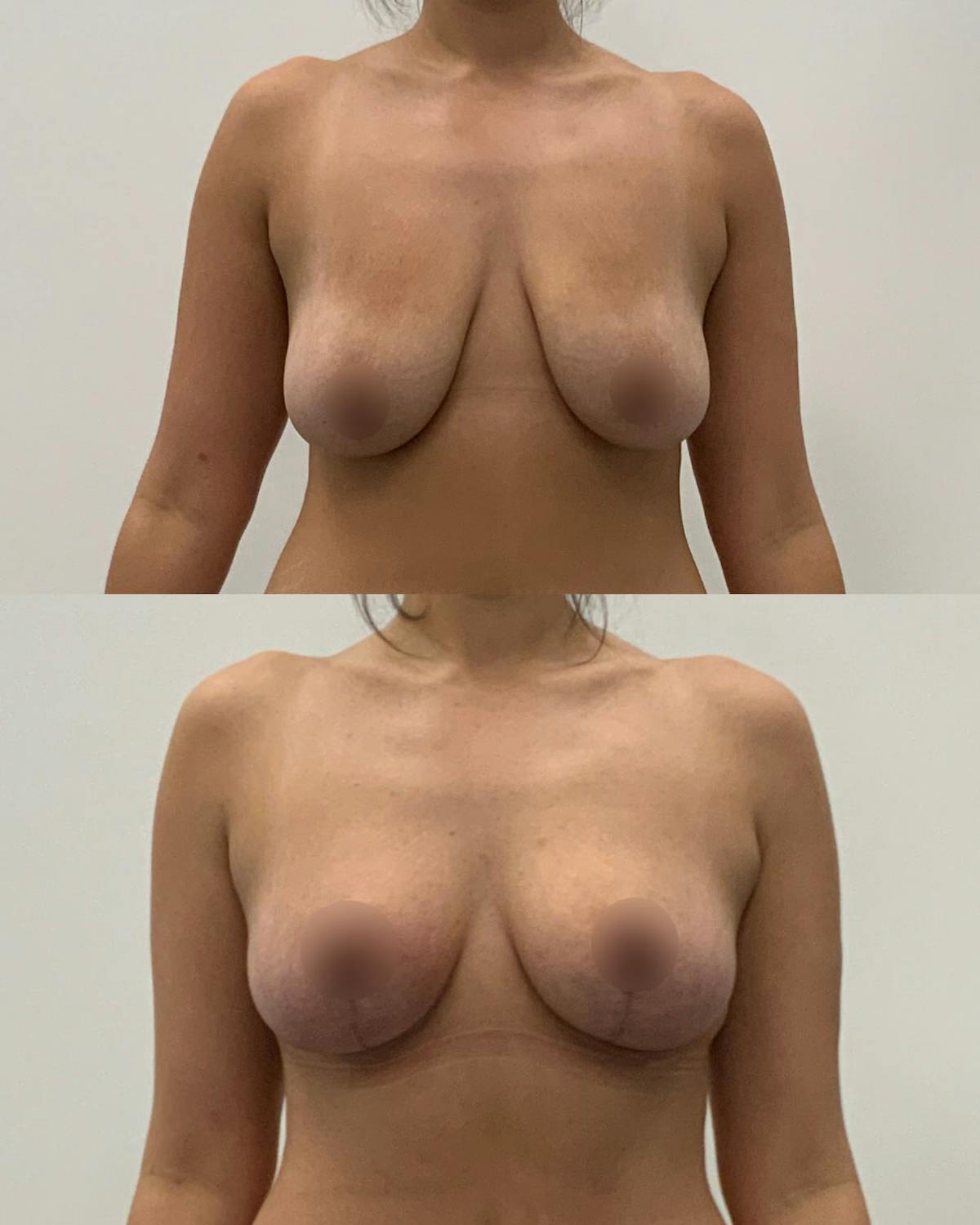 Breast Lift Before & After Gallery - Patient 641658 - Image 1