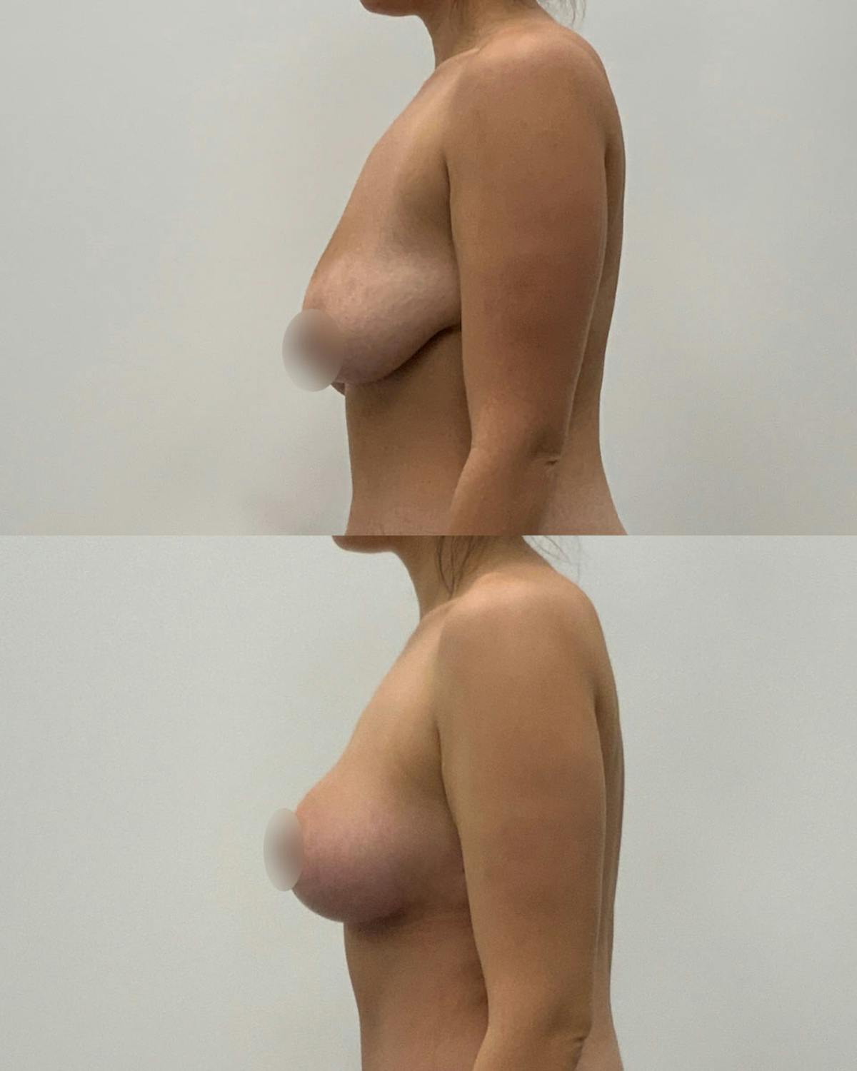 Breast Lift Before & After Gallery - Patient 641658 - Image 3