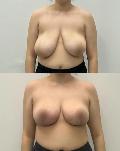 Breast Lift Before & After Gallery - Patient 497834 - Image 1