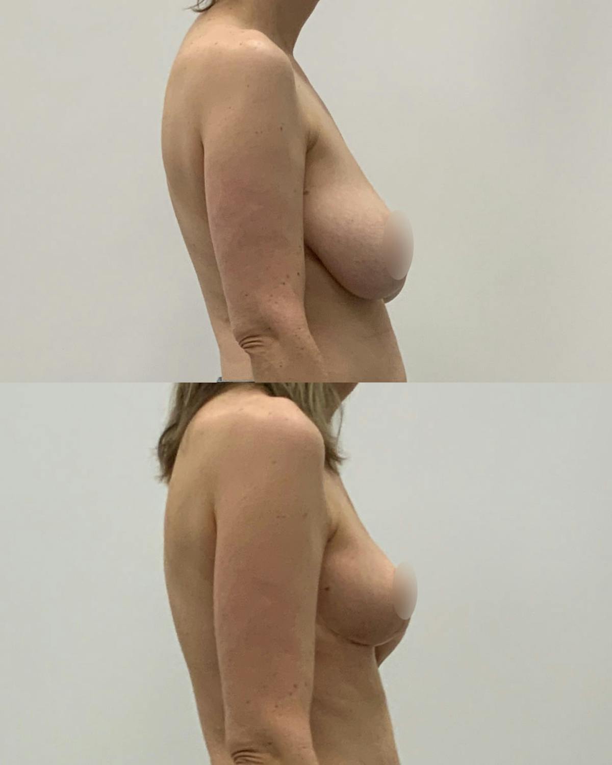 Breast Lift Before & After Gallery - Patient 162844 - Image 3