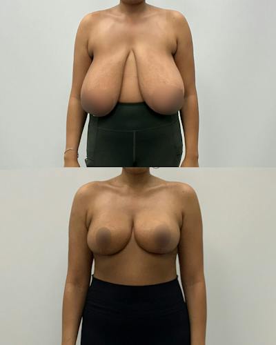 Breast Lift Before & After Gallery - Patient 105371 - Image 1