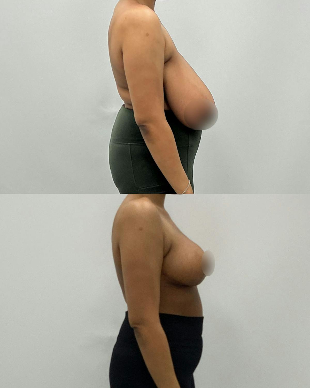 Breast Lift Before & After Gallery - Patient 105371 - Image 3