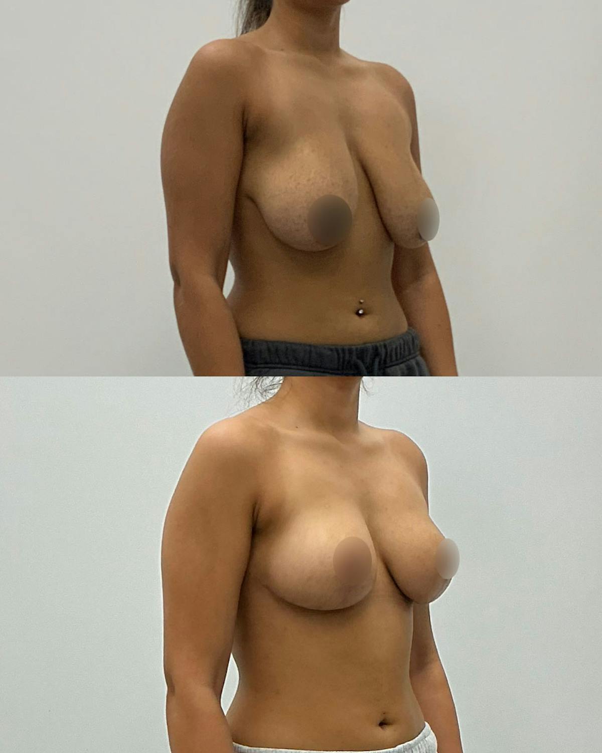 Breast Lift Before & After Gallery - Patient 174066 - Image 2