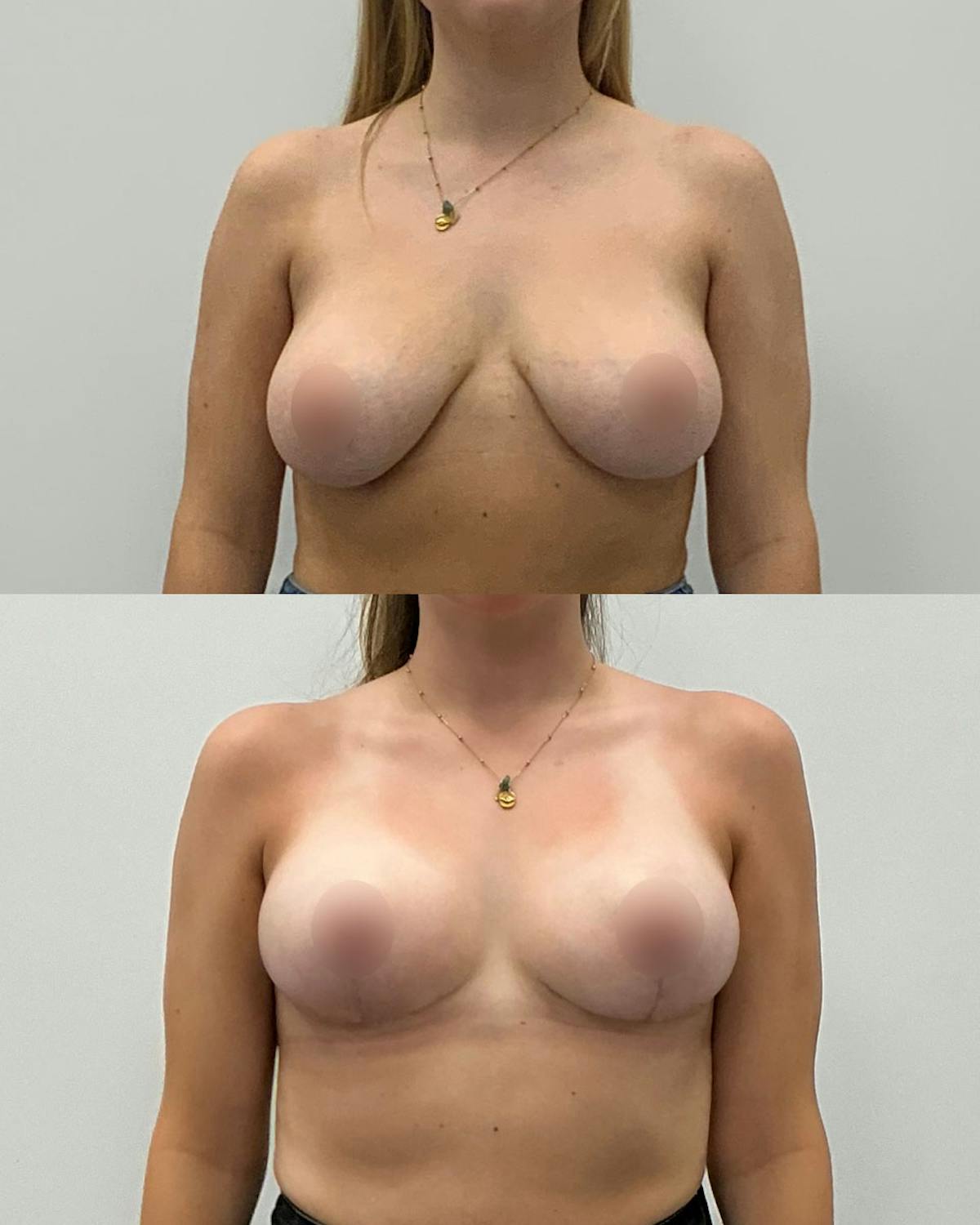 Breast Lift Before & After Gallery - Patient 282665 - Image 1