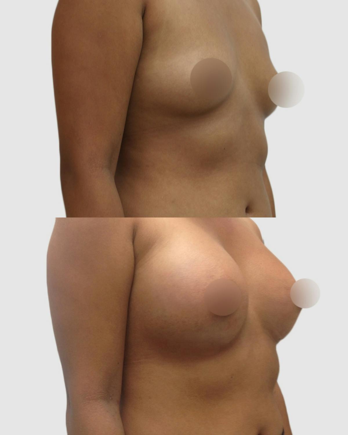 Breast Augmentation Before & After Gallery - Patient 220879 - Image 2