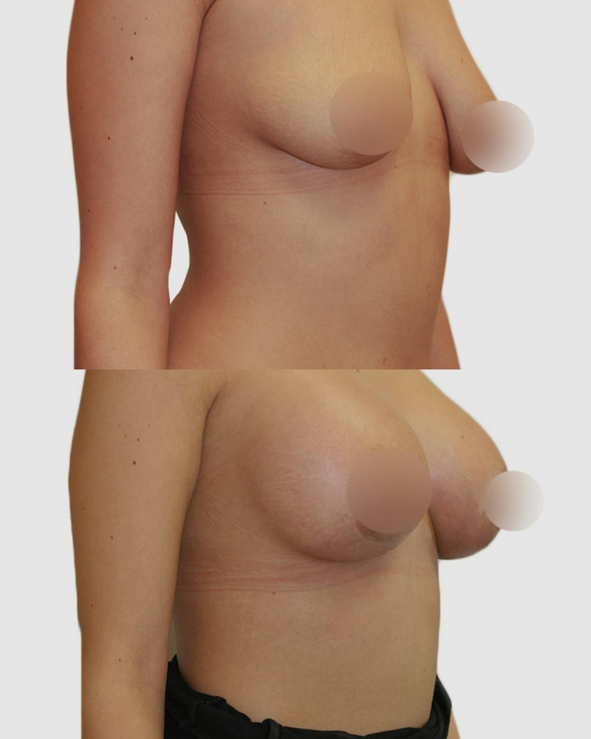 Breast Augmentation Before & After Gallery - Patient 343995 - Image 3