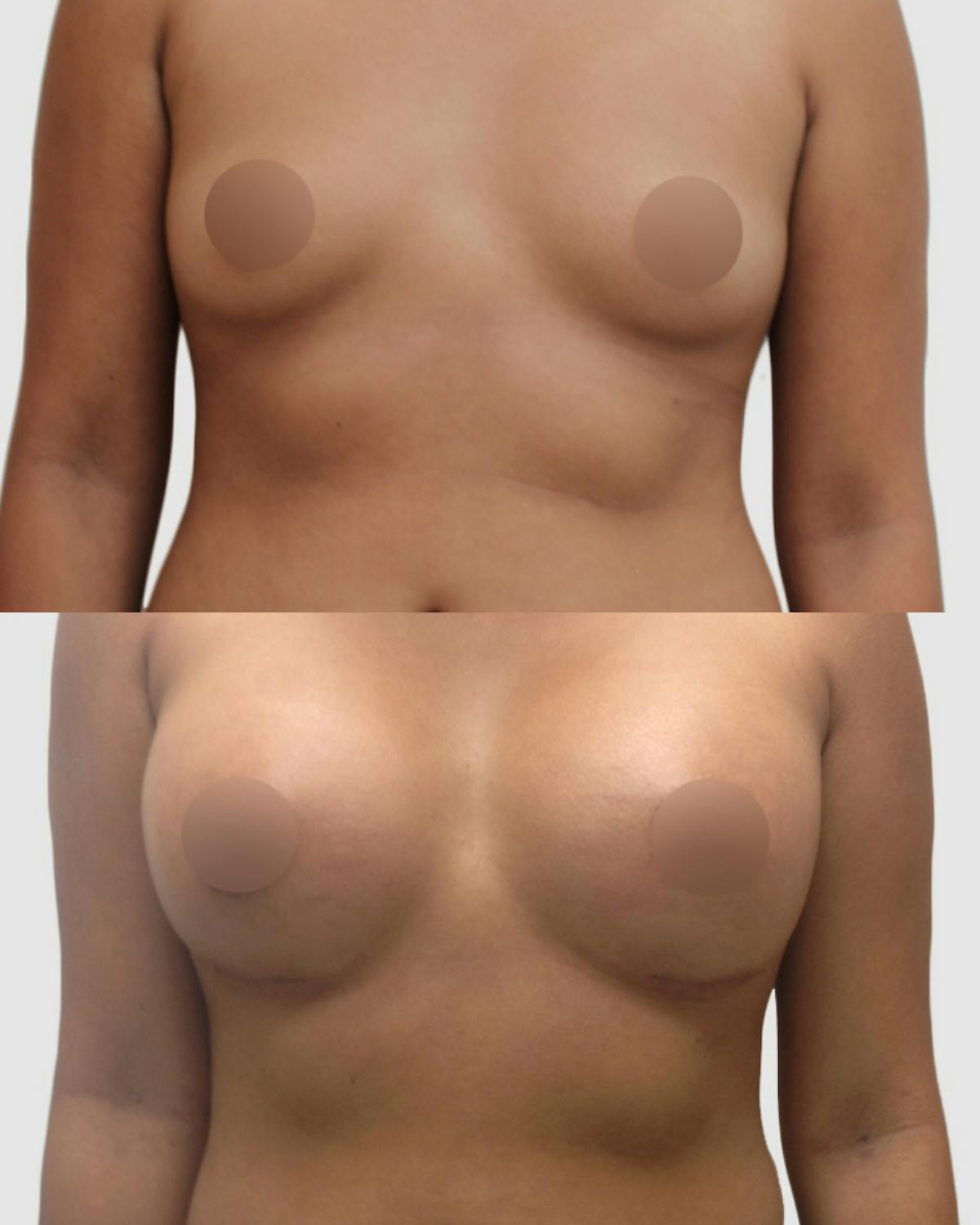 Breast Augmentation Before & After Gallery - Patient 220879 - Image 1