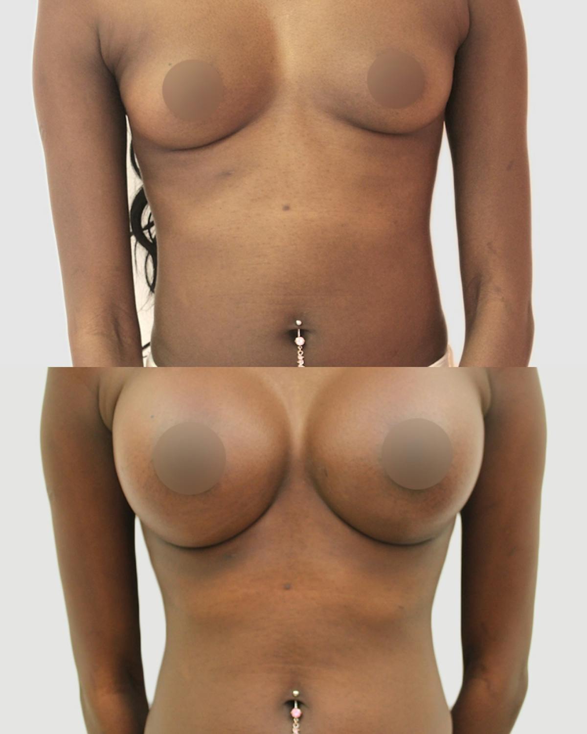 Breast Augmentation Before & After Gallery - Patient 288504 - Image 1