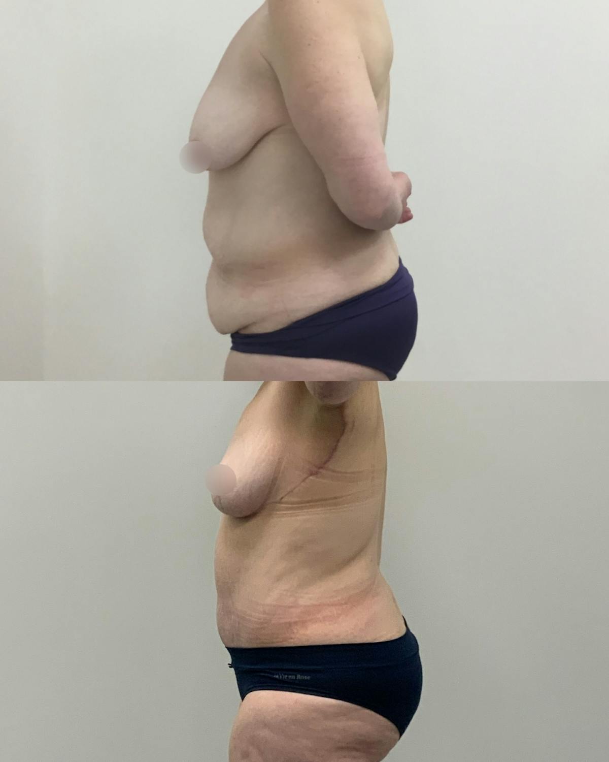 Mommy Makeover Before & After Gallery - Patient 220243 - Image 3