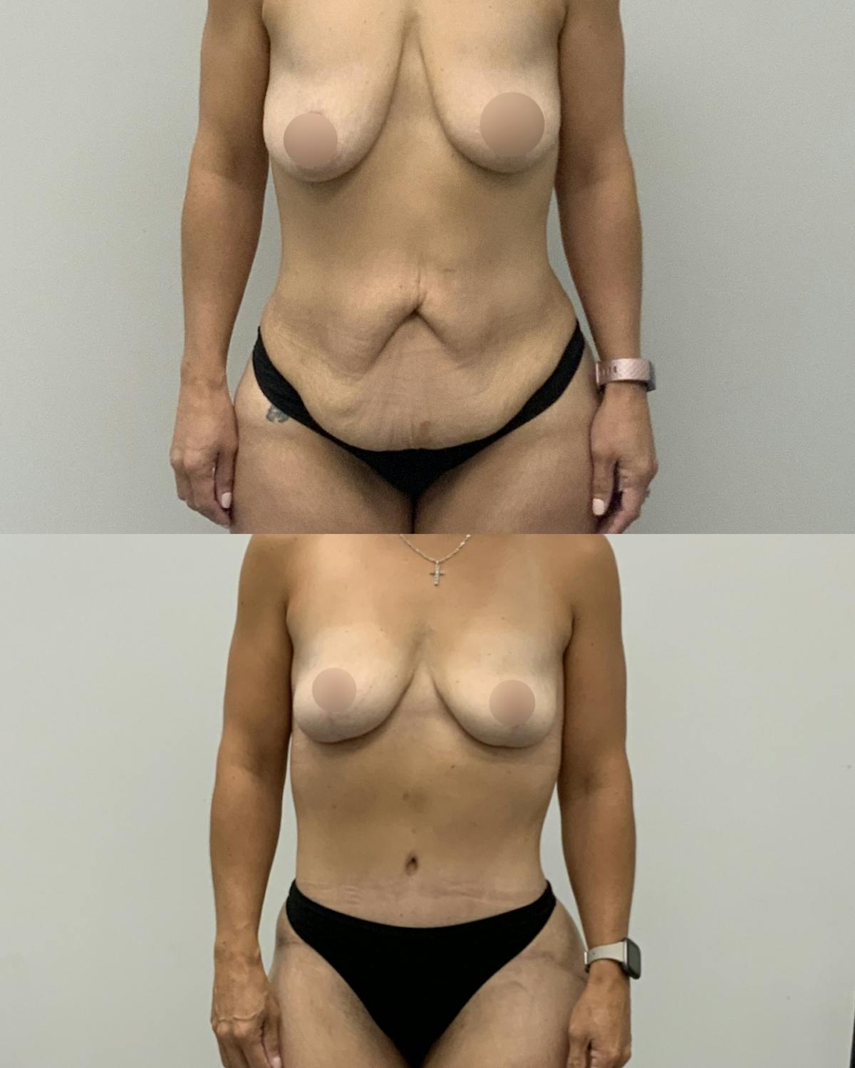 Mommy Makeover Before & After Gallery - Patient 325651 - Image 1