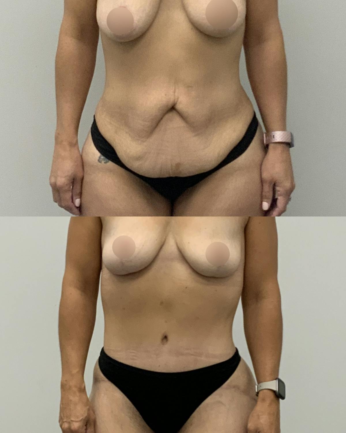 Tummy Tuck Before & After Gallery - Patient 212494 - Image 1