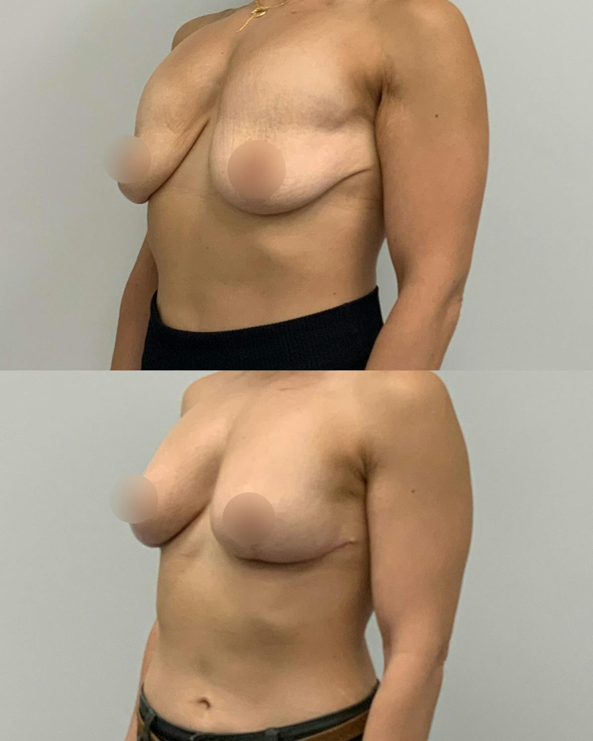 Breast Asymmetry Correction Before & After Gallery - Patient 910251 - Image 2