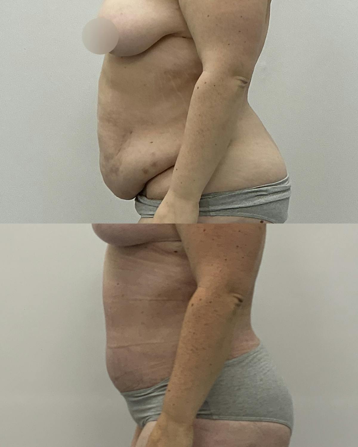 Tummy Tuck Before & After Gallery - Patient 461396 - Image 3